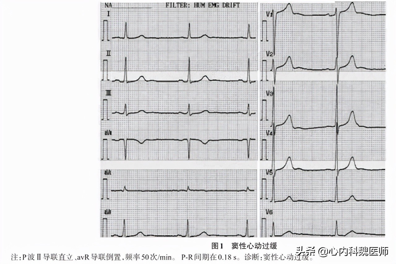 心电图显示窦性心动过缓怎么回事,心电图查出窦性心动过缓严重吗