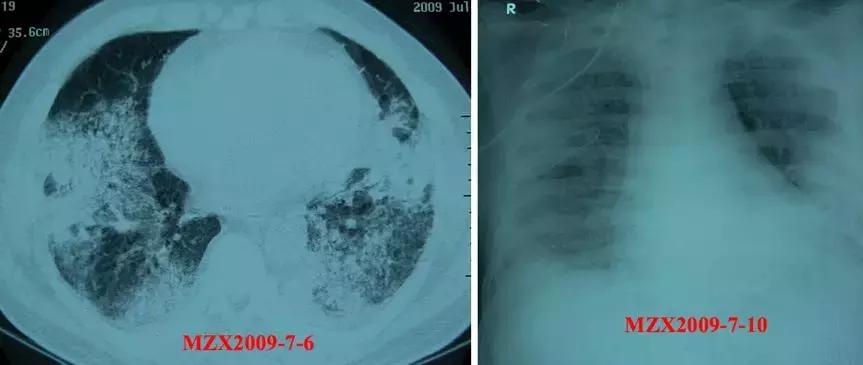 CACP2019:代华平:机化性肺炎的诊疗误区与防范