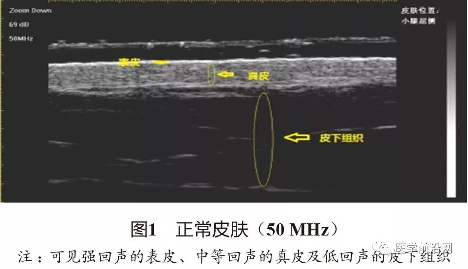 常见皮肤病高频皮肤超声诊断专家共识全文发布