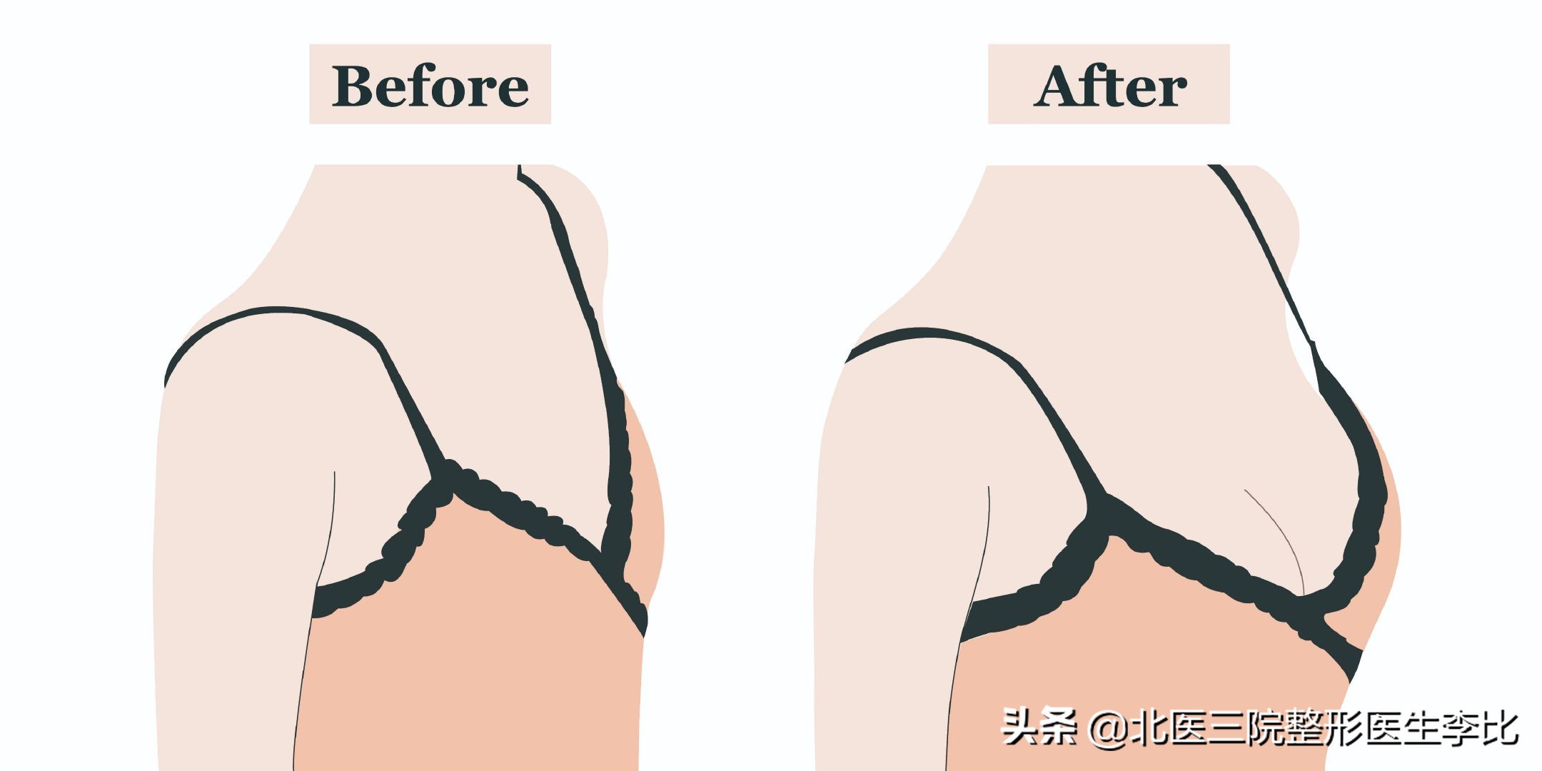 丰胸方法最好的是哪种,丰胸方法千万种到底哪种才靠谱