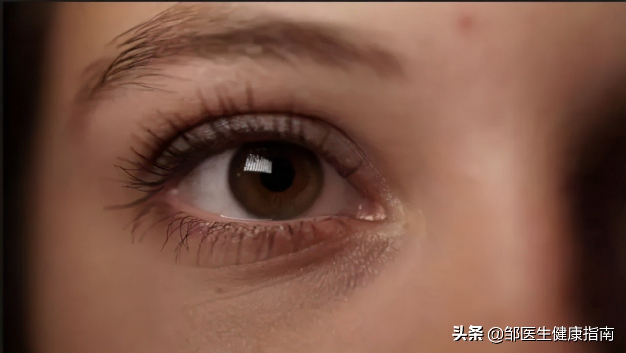 黑眼圈重一定是熬夜造成的吗,黑眼圈真的是熬夜引起的吗