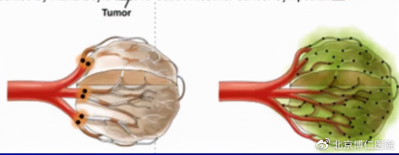 有关肝癌介入治疗的文章,肝癌早发现科普