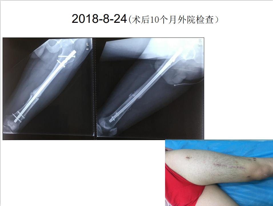 平乐骨科推拿教学,中医治疗骨折畸形愈合