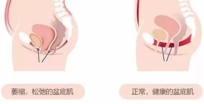顺产底下会松吗？怎么办恢复呢？要不要“紧”呢？