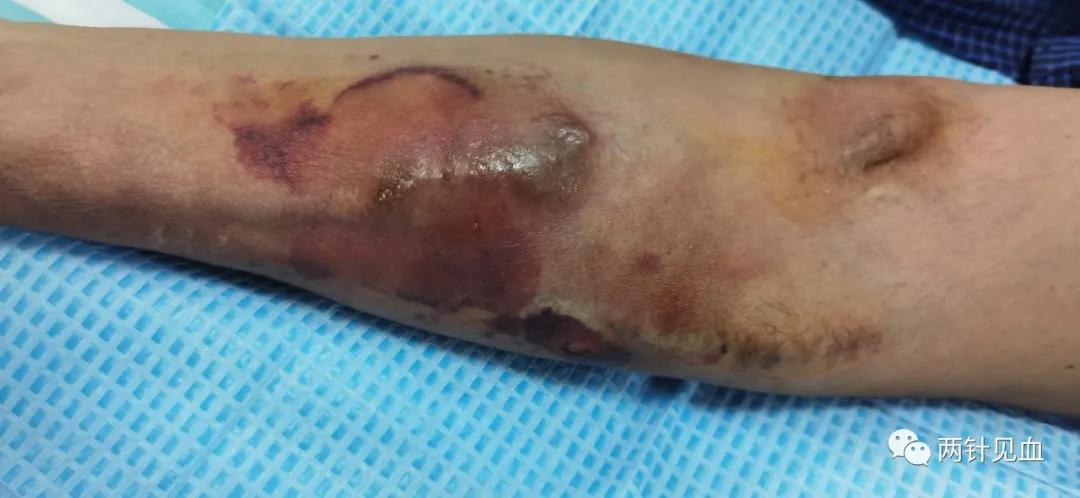 一例内瘘皮肤水泡、溃烂的处理讨论汇总