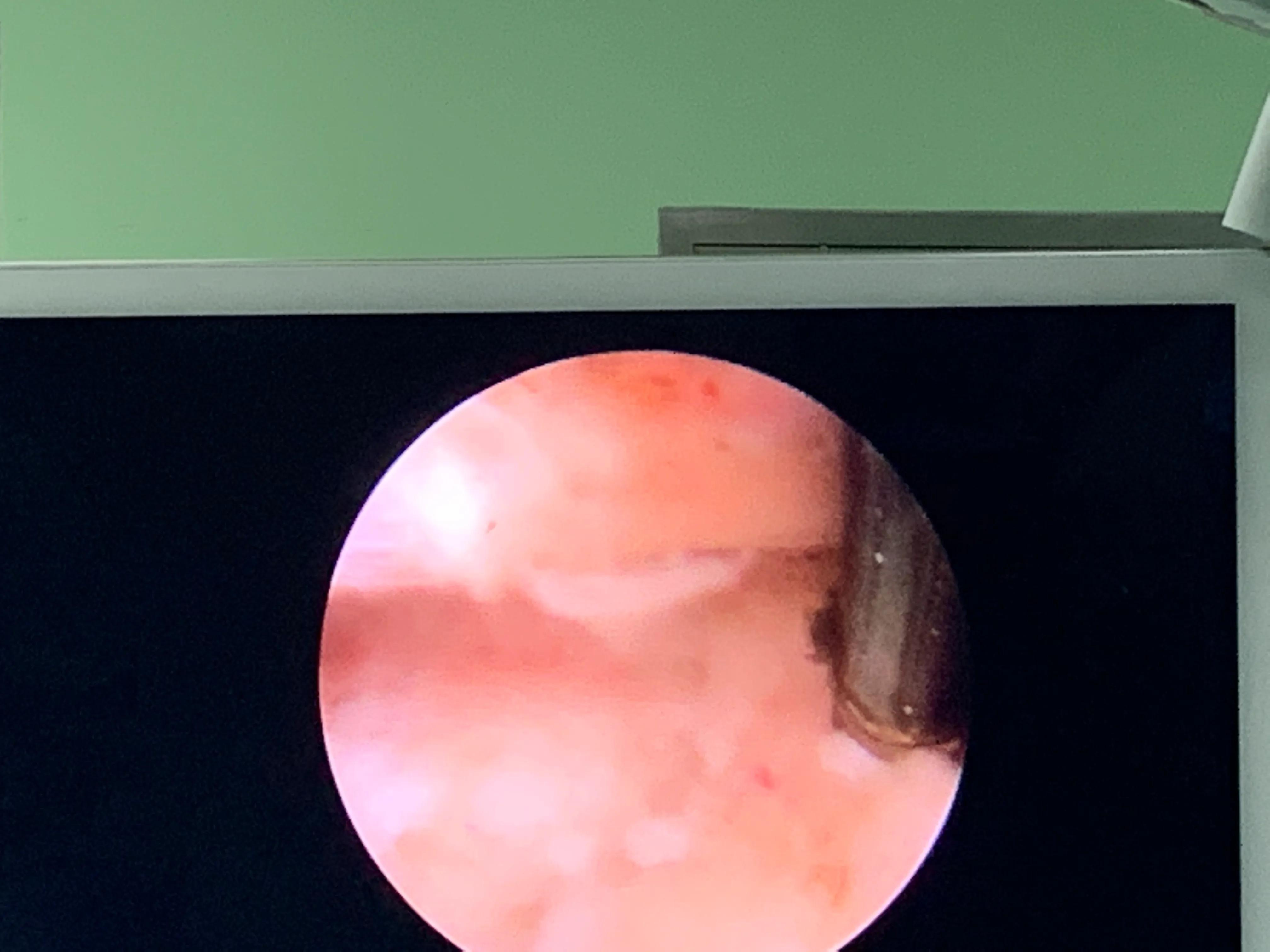 椎间孔镜术后腰痛症状多久消失,盘源性腰痛手术后易复发吗