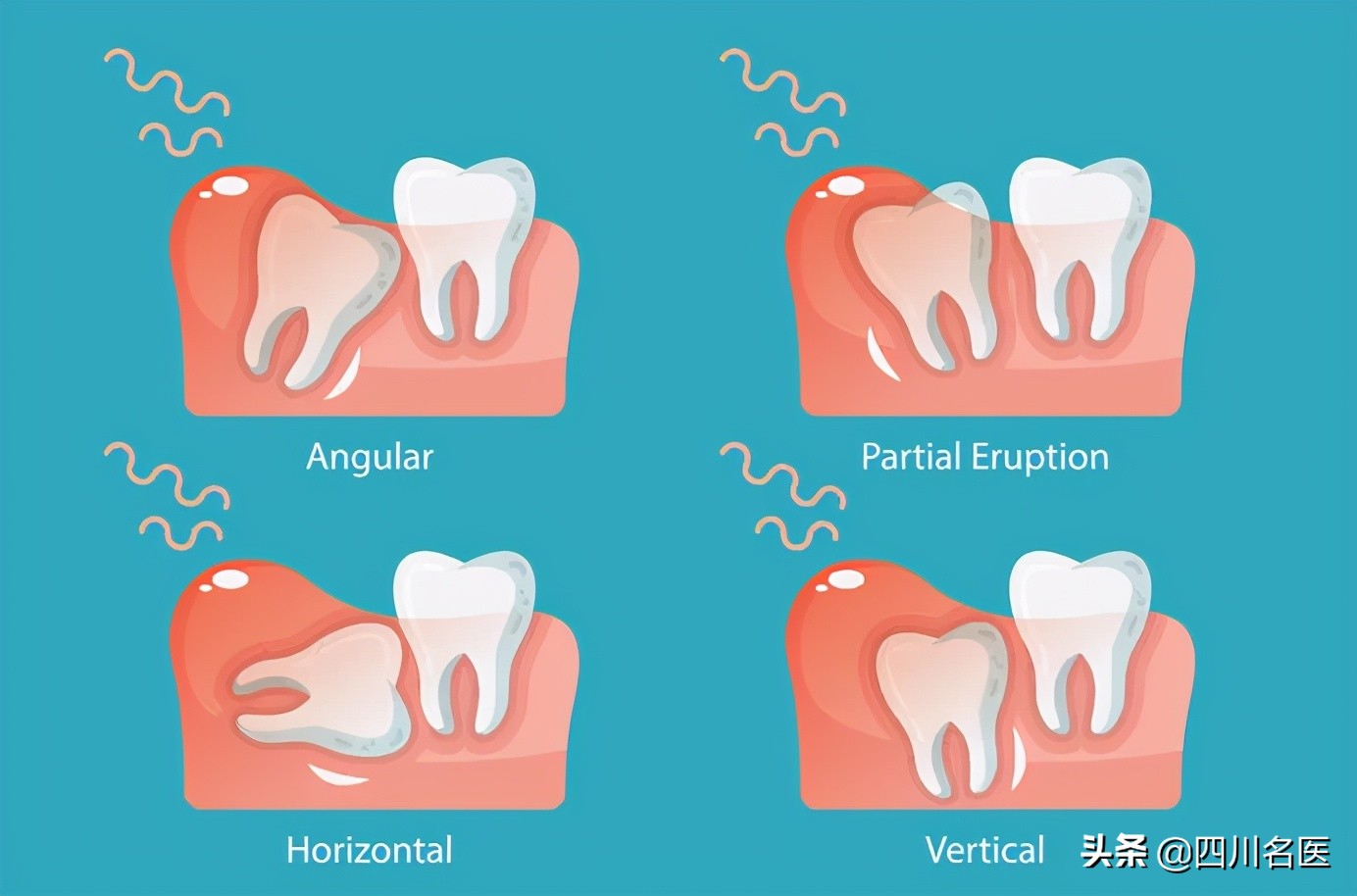 智齿一次拔几颗比较好,智齿到底要不要拔掉一个视频