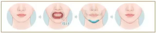 丰下巴可以改善下巴后缩么,丰下巴手术前后对比照片