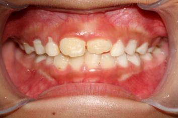 8岁的孩子能做牙齿矫正吗,7岁孩子矫正牙齿早吗