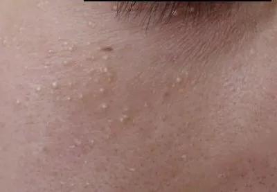 脂肪粒的形成原因以及消除方法,脂肪粒的形成原因以及去除方法