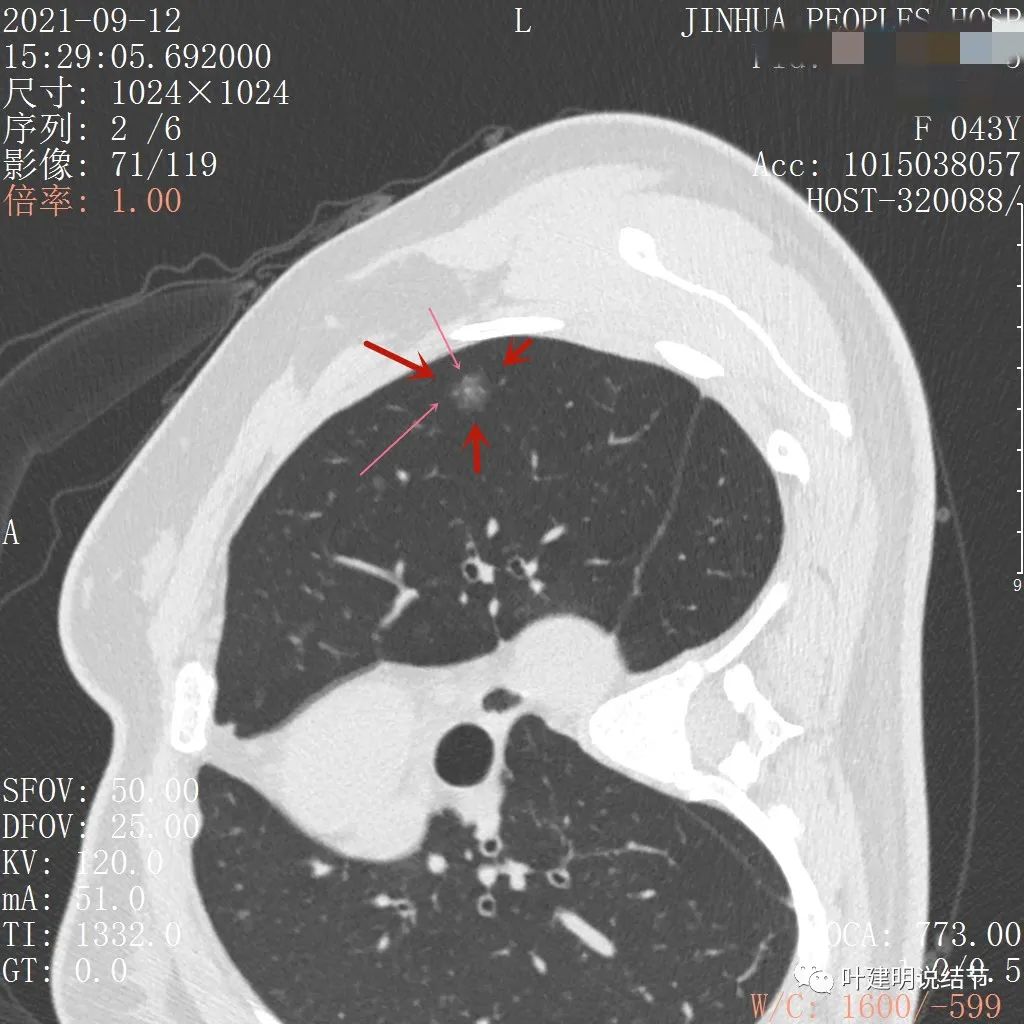 从活检怎么看是非小细胞癌,从病例谈辨证论治
