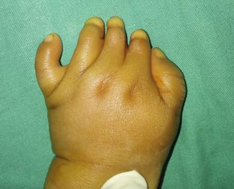 并指畸形免植皮案例,并指畸形