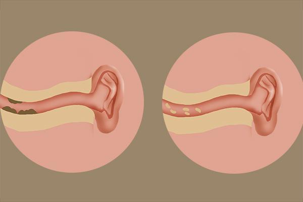 为什么耳朵有耳油流出,为什么有人耳朵里流油