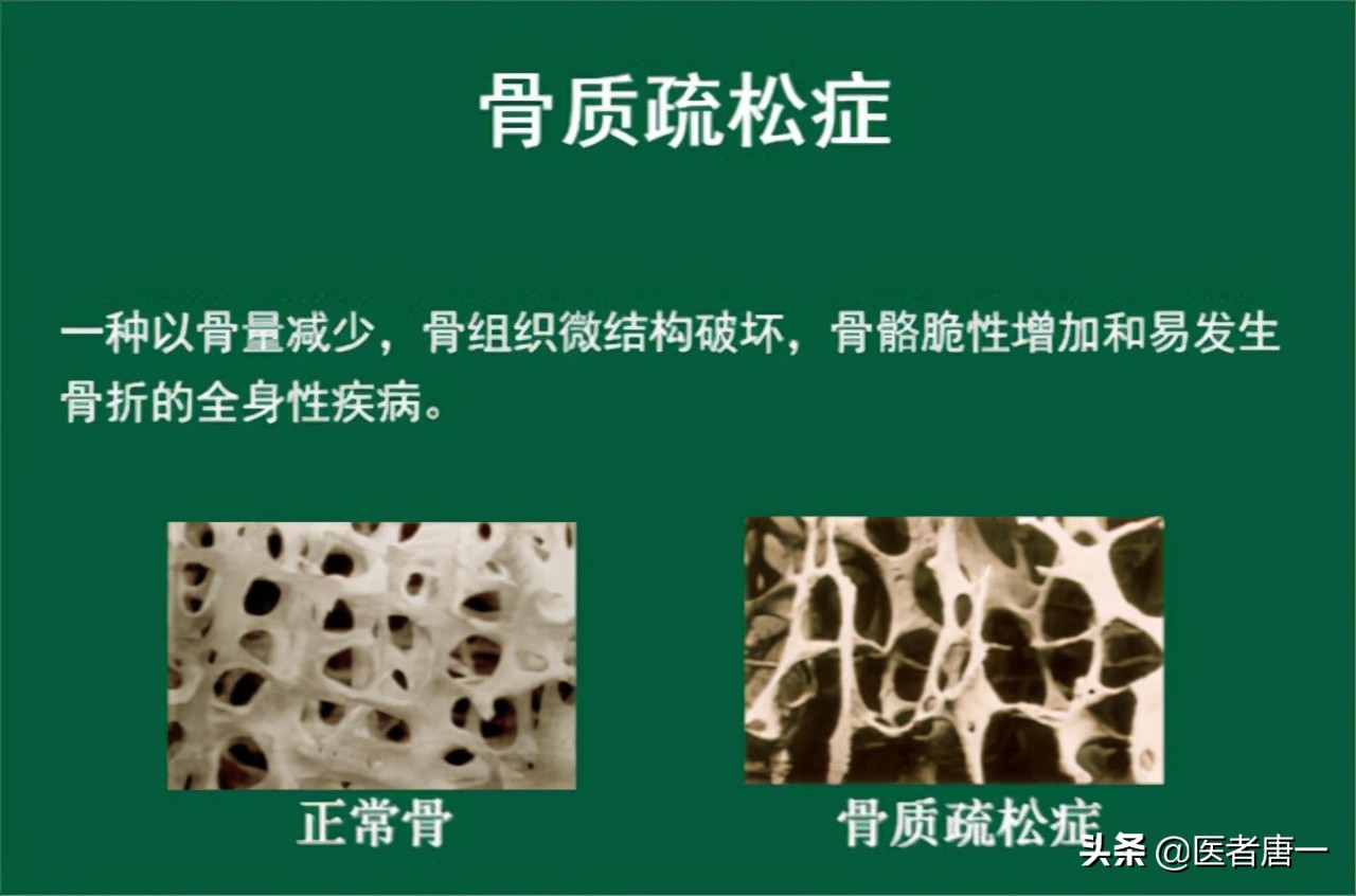 50岁严重的骨质疏松怎么办,女性50岁补钙什么牌子最好