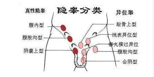 男孩一出生就失去一只眼睛,男性隐睾是先天还是后天的