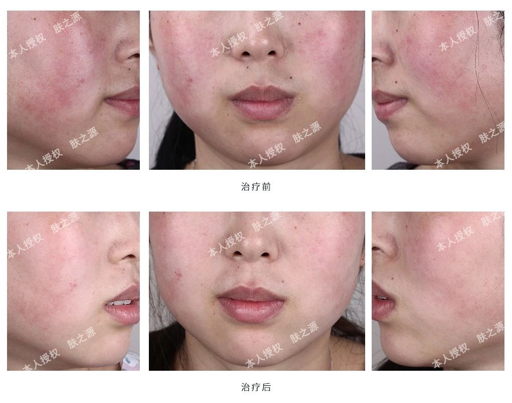 玫瑰痤疮患者自述,治疗玫瑰痤疮案例分享