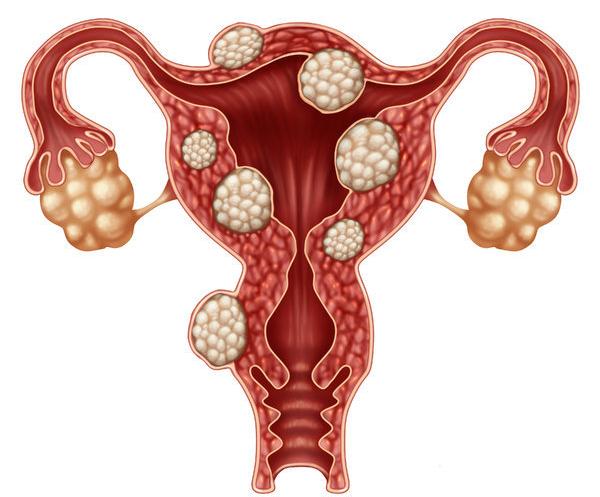 得了肿瘤不要慌,别慌这5种妇科病可能根本不用治