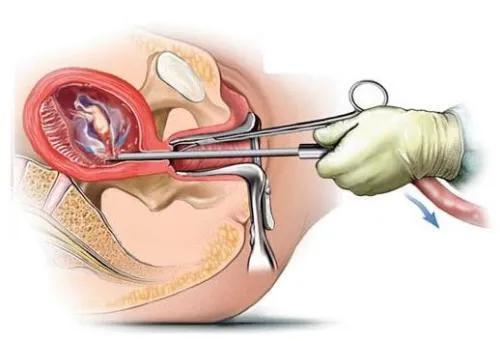 人工流产和引产,6周人工流产手术操作全过程
