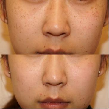 国际上有根除遗传雀斑的方法吗,专业祛斑四天根除遗传性雀斑