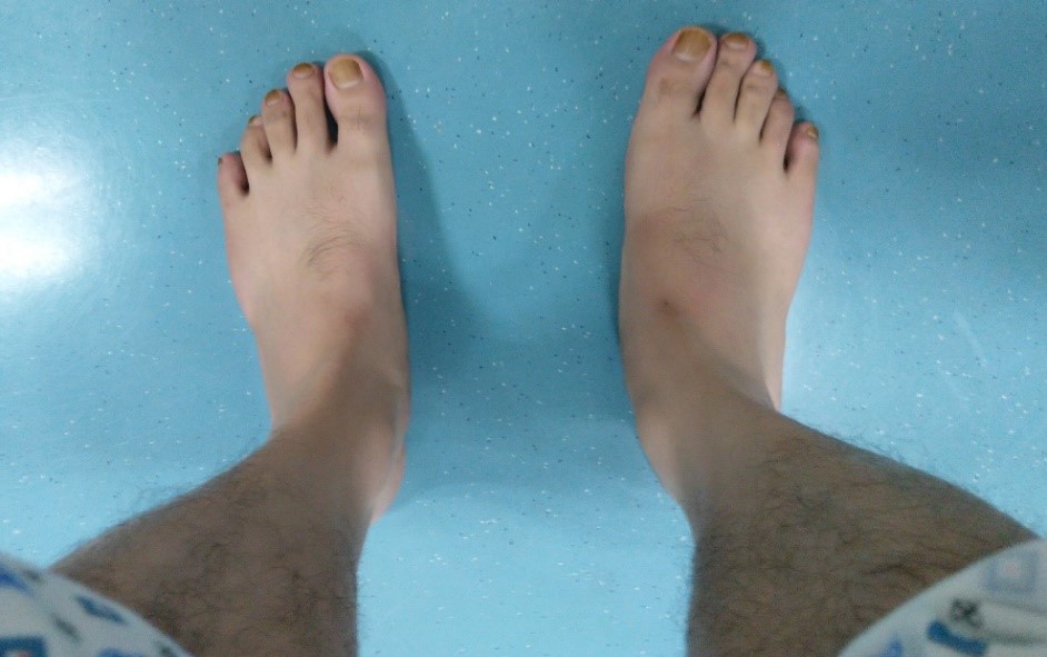 扁平足训练动作,扁平足最佳训练方法