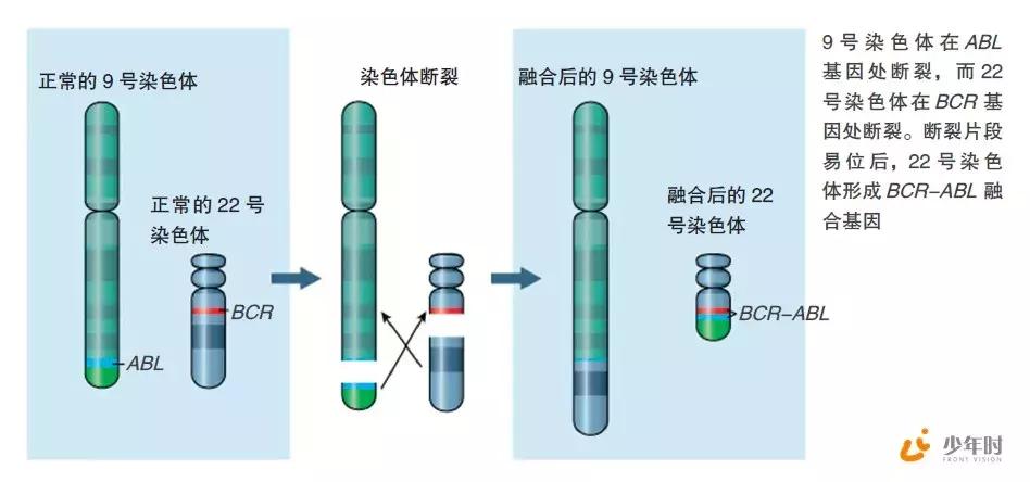 费城染色体形成原因,费城染色体会有什么影响