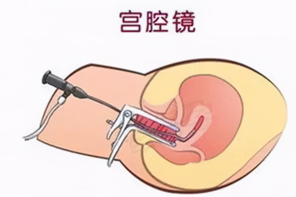 宫腔镜手术前需要做宫腔镜检查吗,试管婴儿前必须要做腹腔镜吗