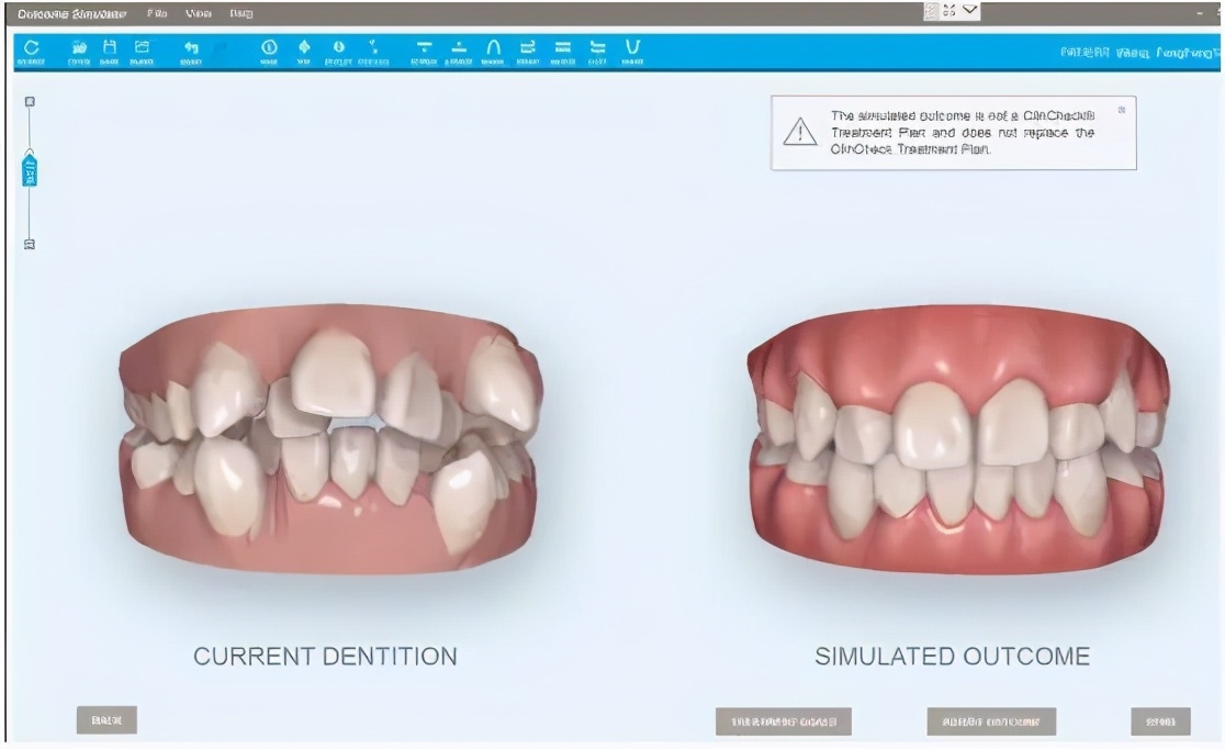 牙齿矫正能进考场吗,牙齿矫正高考有影响吗