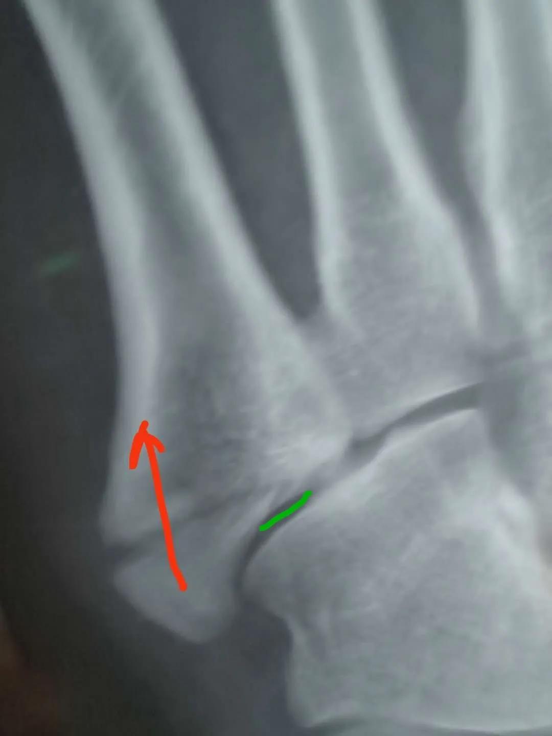 第五跖骨基底部骨折60天能走路吗,第五跖骨基底部骨折60天能脱拐吗