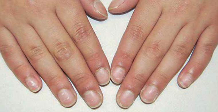 宝宝指甲出现白点,孩子指甲上有白色斑点倪海厦