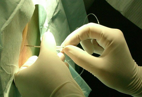 无痛分娩麻药会引起发烧吗,无痛分娩打麻药会不会影响记忆