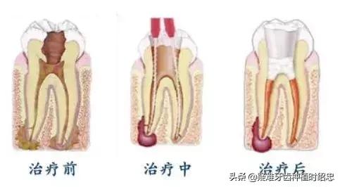 大熊猫根管治疗,戴牙冠真的能保护好正常基牙吗