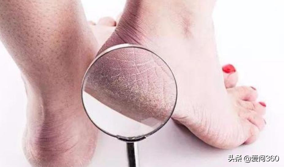 中老年人脚后跟开裂，大多是这些原因造成的，5个方法可改善