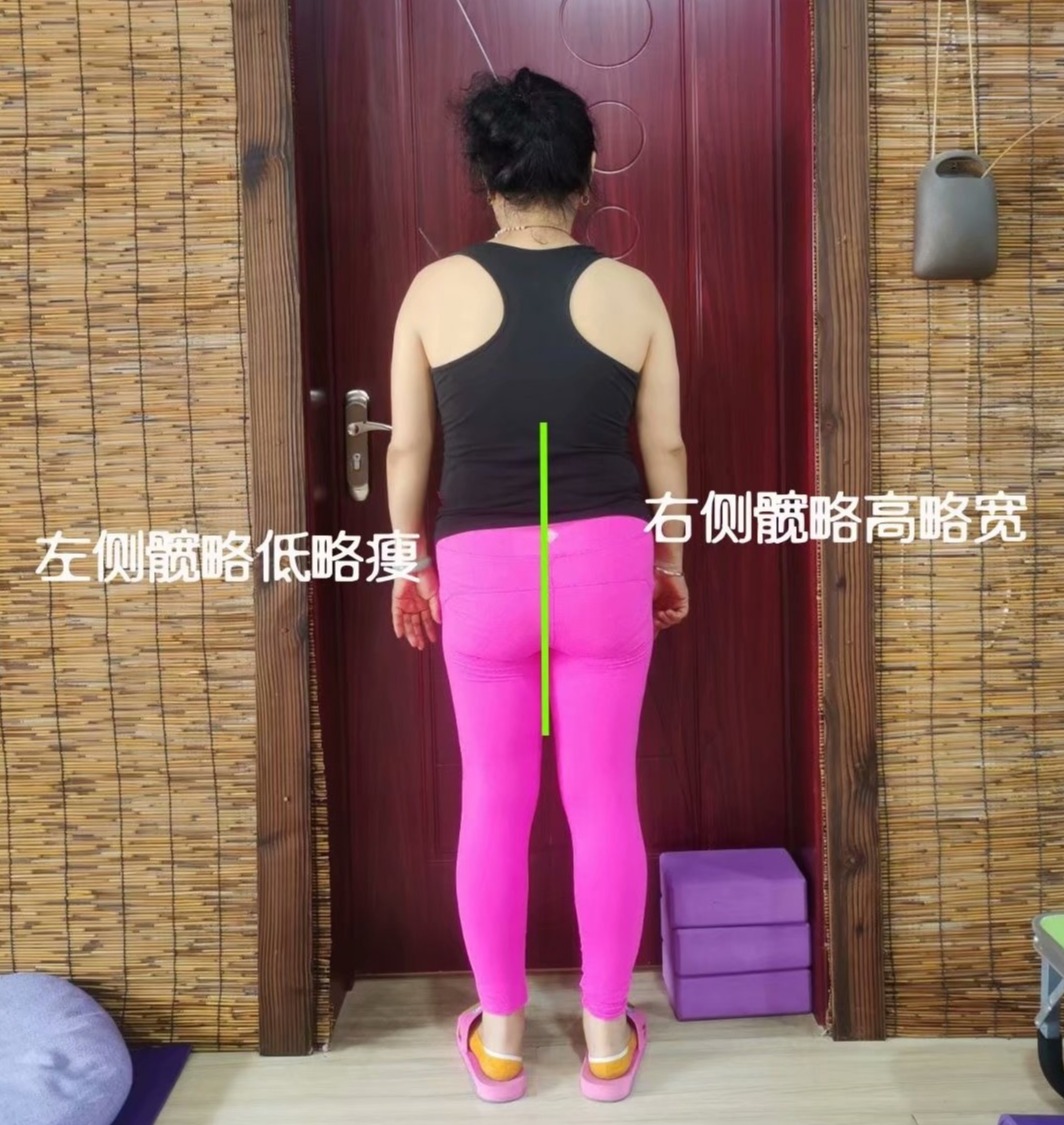 左右骨盆角度不一样,左侧骨盆比右侧骨盆突出怎么调整