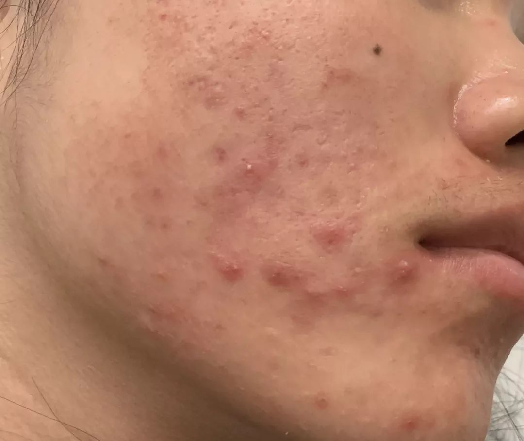 治痘痘维a酸类药膏哪个好,异维a酸胶囊可以永久治好痘痘吗