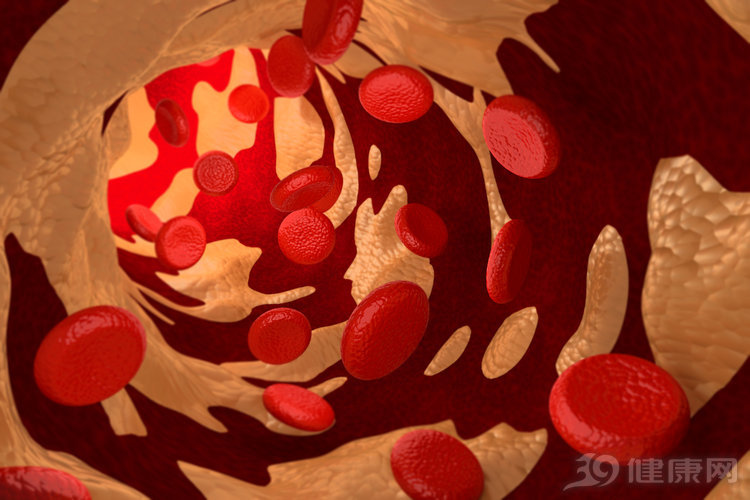 阿司匹林可以使颈动脉斑块减小么,颈动脉斑块吃降血脂药能消失吗