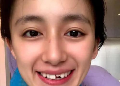 吴宣仪烤瓷牙怎么做,吴宣仪的整牙前