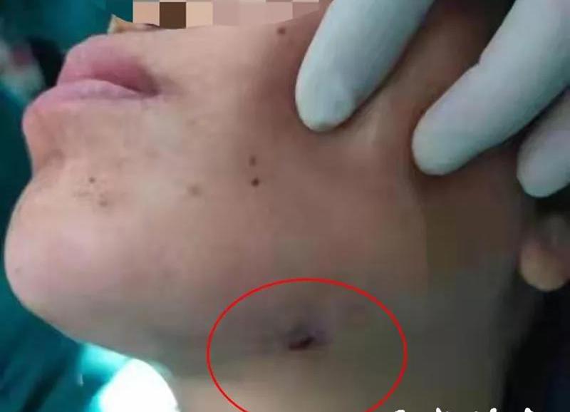 智齿发炎持续1个月怎么处理,智齿破了一个洞老是发炎