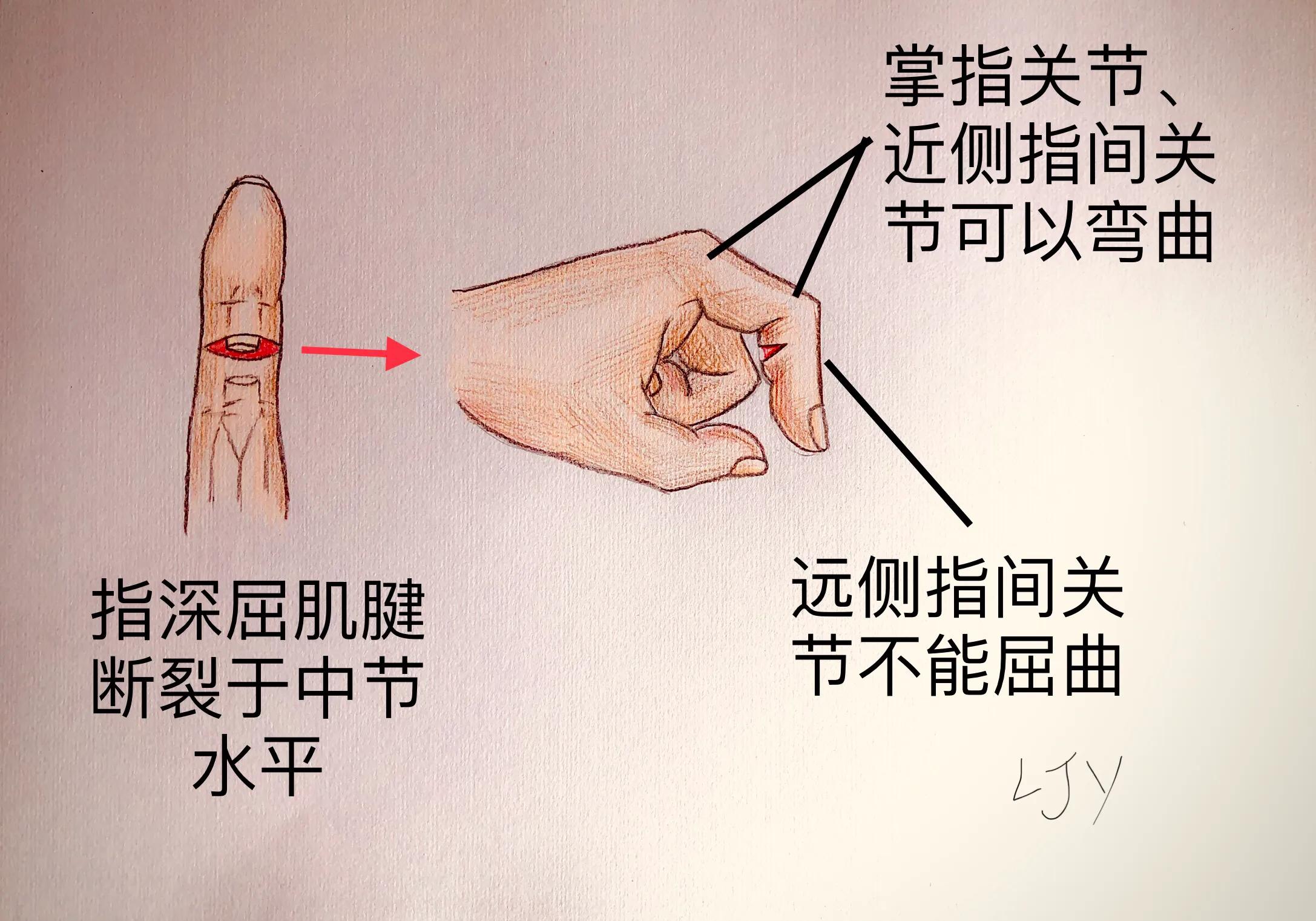 手被割伤如何处理,手被割伤了较深要如何处理