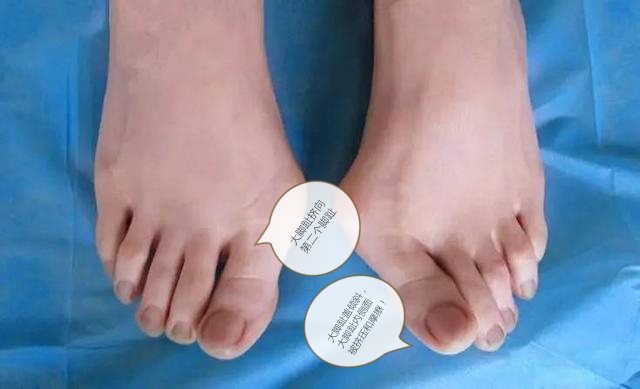 大脚趾外翻有什么可以治疗的,大脚趾外翻后遗症