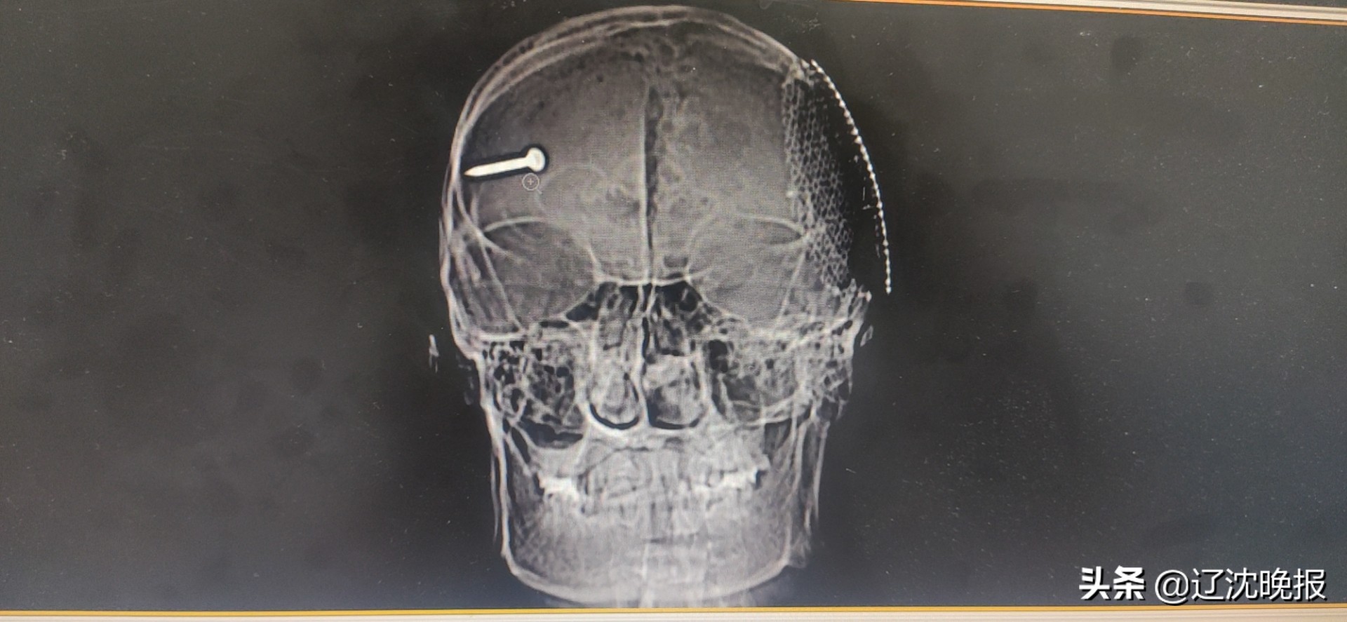 钢钉射进大脑后续,钢钉反弹扎进眼睛9个小时才手术