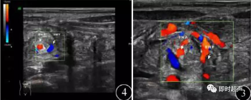 小儿消化道急症超声