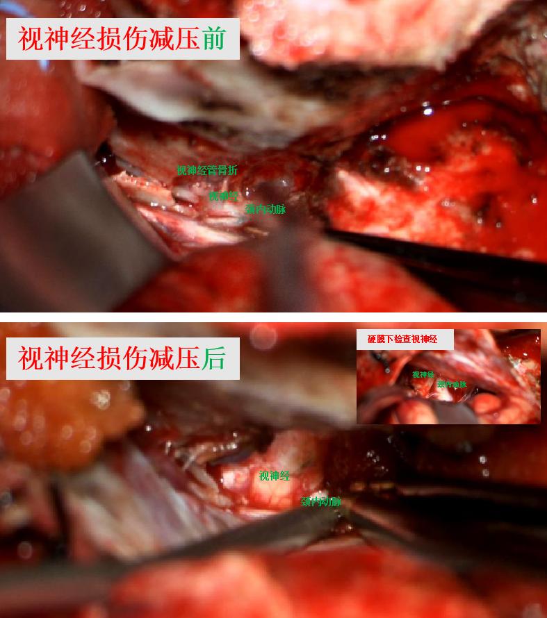 车祸眼部神经受损失明可以修复吗,车祸视神经压迫失明的恢复几率
