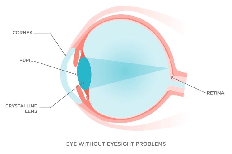 近视眼手术晶体移植和激光的区别,近视眼做了激光有什么利弊