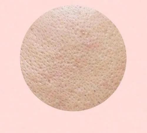 毛孔粗大公认解决方法,毛孔粗大最简单有效的方法