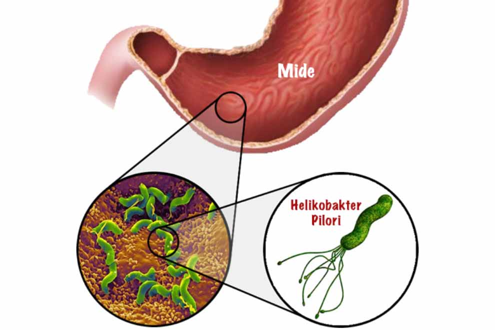 胃溃疡怎么吃醪糟,胃溃疡怎么吃豆腐