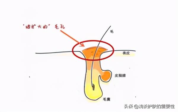 鼻子上的毛孔大有什么方法,鼻子周围毛孔大怎么收缩