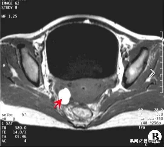发现硬块是什么原因,发现包块是癌症晚期吗