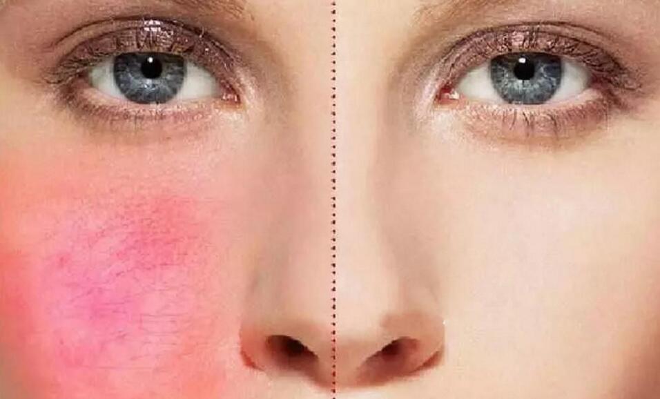 脸上红血丝怎么修复可以彻底治愈,血丝怎么能快速消除