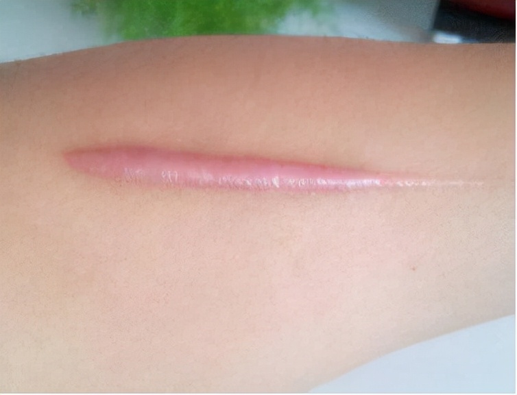 刀口增生了怎么消除？