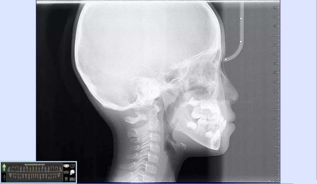 拍牙x光片对身体有什么危害,牙齿拍了几次x光片的危害